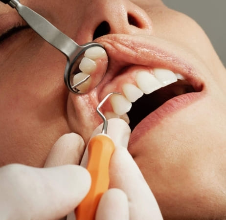 teeth cleaning