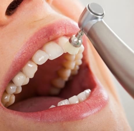 teeth polishing