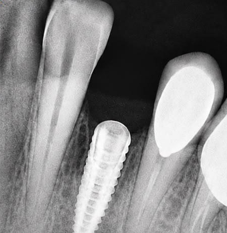 X-ray showing a dental implant placed between natural teeth